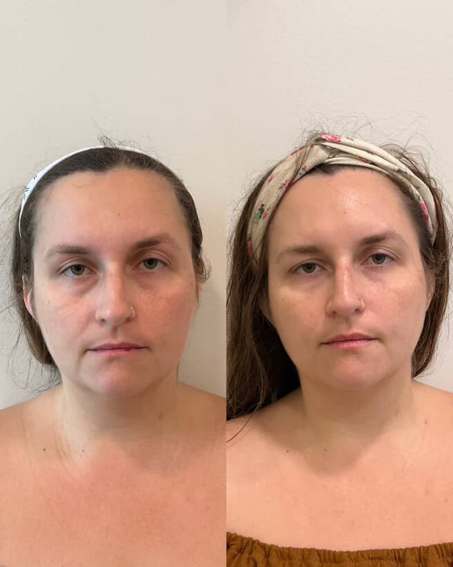 vampire filler ; PRP Injection